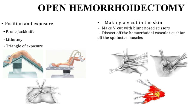Hemorrhoidectomy Surgical Procedure RAF pptx Digestive Disorders 