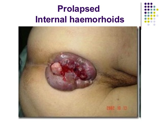 hemorrhoids