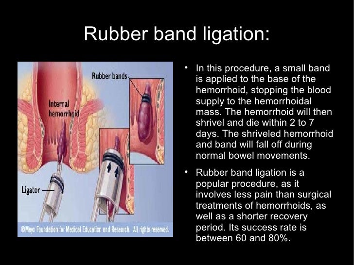 Hemorrhoids Treatments