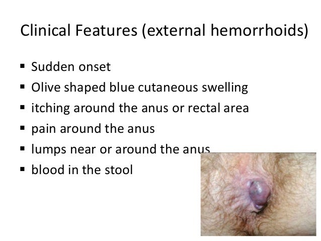 Perianal Hematoma Vs External Hemorrhoid - maternity photos