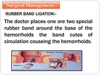 The doctor places one ore two special
rubber band around the base of the
hemorrhoids the band cutes of
circulation couseing the hemorrhoids.
 