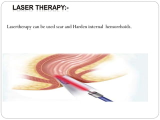Lasertherapy can be used scar and Harden internal hemorrhoids.
 