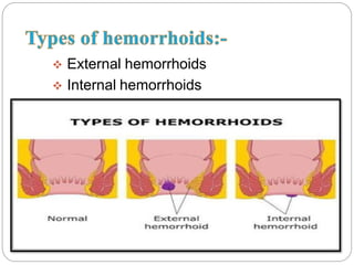  External hemorrhoids
 Internal hemorrhoids
 