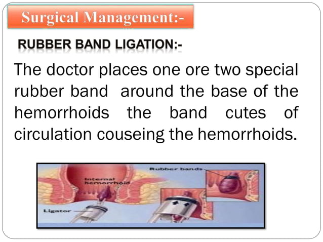 Hemorrhoids Ppt Hemorrhoids Ppt