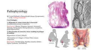 Pathophysiology
 Central Hallmark of hemorrhoidal disease (Symptomatic)
is the swelling of sinusoids
Core Etiologies:
1- Reduction of venous return due to increased
intraabdominal pressure (congestion)
Risk Factors: Obesity, Pregnancy (pressure, hormones),
Straining, Sitting position during defecation, constipation,
portal hypertension*
2- Deterioration of connective tissue resulting in prolapse
of cushions
Degeneration of Treitz’s Muscle
Abnormalities in Collagen or Elastic Fibers (causes
congestion)
Risk Factors: Normal Aging, Diarrhea, Genetics (Ehlers-
Danlos Syndrome, Scleroderma)
 