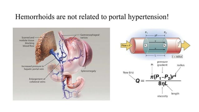 Hemorrhoids.pptx
