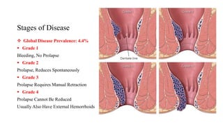 Stages of Disease
 Global Disease Prevalence: 4.4%
 Grade 1
Bleeding, No Prolapse
 Grade 2
Prolapse, Reduces Spontaneously
 Grade 3
Prolapse Requires Manual Retraction
 Grade 4
Prolapse Cannot Be Reduced
Usually Also Have External Hemorrhoids
 