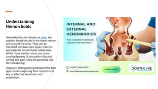 Understanding
Hemorrhoids
Hemorrhoids, also known as piles, are
swollen blood vessels in the lower rectum
and around the anus. They can be
classified into two main types: internal
and external hemorrhoids called piles.
While these swollen veins can cause
varying degrees of discomfort like anal
itching and pain, they are generally not
life-threatening.
However, distinguishing between the two
types and recognizing their symptoms is
key to effective treatment and
prevention.
 