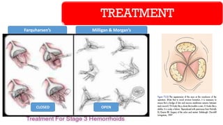 TREATMENT
Farquharsen’s Milligan & Morgan’s
CLOSED OPEN
 