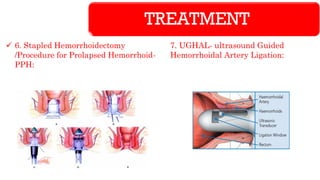 TREATMENT
✓ 6. Stapled Hemorrhoidectomy
/Procedure for Prolapsed Hemorrhoid-
PPH:
7. UGHAL- ultrasound Guided
Hemorrhoidal Artery Ligation:
 