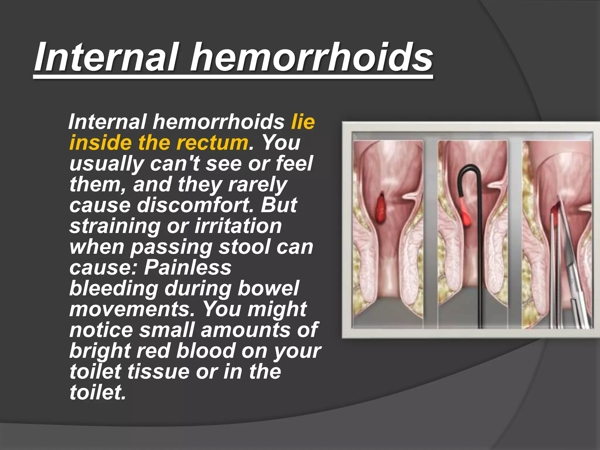 Hemorrhoids 1 pptx