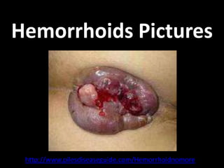 Hemorrhoids Pictures




 http://www.pilesdiseaseguide.com/Hemorrhoidnomore
 