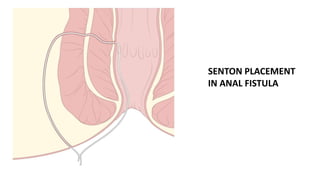 Hemorrhoids, anal fissure, anal fistula, anal abscess | PPTX