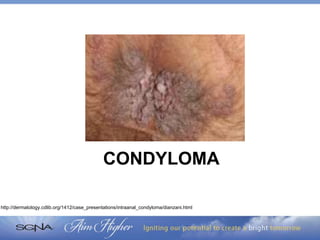 Kiss Your Hemorrhoids Goodbye: Surgical and Non-Surgical Management ...