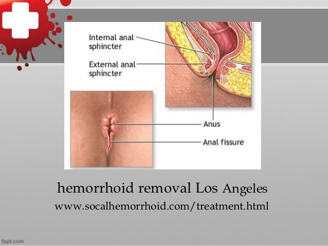 What causes hemorrhoids?