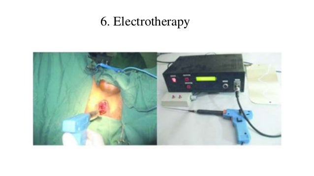 advil paracetamol Types : 10 Treatment Of Hemorrhoid Medical Hemorrhoid advil paracetamol Types : 10 Treatment Of Hemorrhoid Medical Hemorrhoid