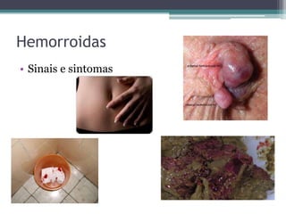 Hemorroidas
• Sinais e sintomas
 
