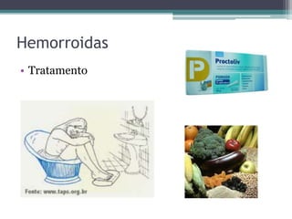 Hemorroidas
• Tratamento
 