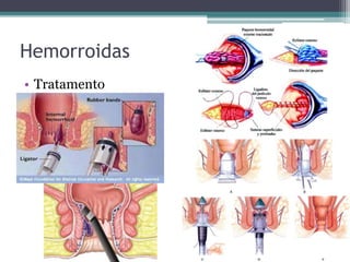 Hemorroidas
• Tratamento
 