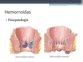 Hemorroidas
• Fisiopatologia
 