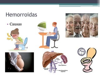 Hemorroidas
• Causas
 