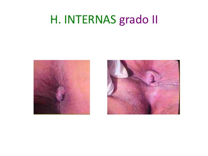 Tratamiento Hemorroides Externas | hemorroides Tratamiento Hemorroides Externas | hemorroides