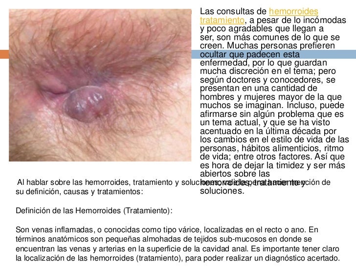 Hemorroides Tratamiento Hemorroides Tratamiento