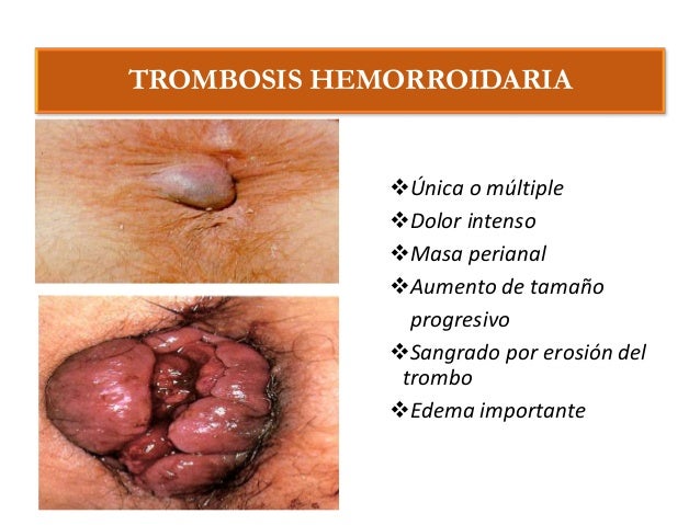 Hemorroides