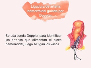 Ligadura de arteria
hemorroidal guiada por
Doppler
Se usa sonda Doppler para identificar
las arterias que alimentan el plexo
hemorroidal, luego se ligan los vasos.
 
