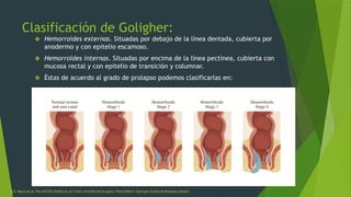 hemorroides-presentacion-de-generalidades-pptx