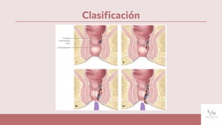 Clasiﬁcación
 