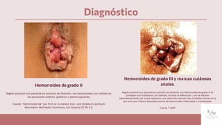 Diagnóstico
Hemorroides de grado II
Región perianal con paciente en posición de litotomía. Las hemorroides son visibles en
las posiciones anterior, posterior y lateral izquierda.
Fuente: “Hemrrhoids 04” por Prof. Dr. A. Herold, End- und Dickdarm-Zentrum
Mannheim, Wikimedia Commons, con licencia CC BY 3.0.
Hemorroides de grado III y marcas cutáneas
anales.
Región perianal con paciente en posición de litotomía. Las hemorroides de grado III se
prolapsan con el esfuerzo, por ejemplo, durante la defecación, y no se reducen
espontáneamente, por lo que requieren una reducción manual. Hay múltiples marcas en la
piel anal, que indican episodios previos de hemorroides inﬂamadas o trombosadas.
Fuente: © IMPP
 