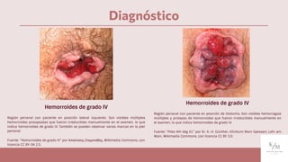 Diagnóstico
Hemorroides de grado IV
Región perianal con paciente en posición lateral izquierdo. Son visibles múltiples
hemorroides prolapsadas que fueron irreducibles manualmente en el examen, lo que
indica hemorroides de grado IV. También se pueden observar varias marcas en la piel
perianal.
Fuente: “Hemorroides de grado IV” por Απόστολος Σταματιάδης, Wikimedia Commons, con
licencia CC BY-SA 2.5.
Hemorroides de grado IV
Región perianal con paciente en posición de litotomía. Son visibles hemorragias
múltiples y prolapso de hemorroides que fueron irreducibles manualmente en
el examen, lo que indica hemorroides de grado IV.
Fuente: “Piles 4th deg 01” por Dr. K.-H. Günther, Klinikum Main Spessart, Lohr am
Main, Wikimedia Commons, con licencia CC BY 3.0.
 