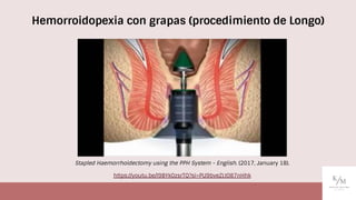 Stapled Haemorrhoidectomy using the PPH System - English. (2017, January 18).
https://youtu.be/l9BYk0zsrTQ?si=PU9bveZLt087nHhk
Hemorroidopexia con grapas (procedimiento de Longo)
 