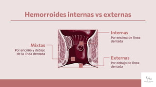 Hemorroides internas vs externas
Mixtas
Internas
Por encima de línea
dentada
Por encima y debajo
de la línea dentada
Externas
Por debajo de línea
dentada
 