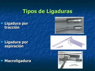 Tipos de Ligaduras Ligadura por tracción Ligadura por aspiración Macroligadura 