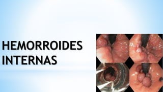 HEMORROIDES
INTERNAS
 