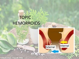 TOPIC :
HEMORROIDS
 