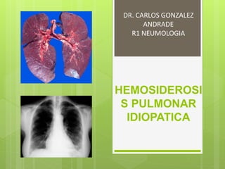 HEMOSIDEROSI
S PULMONAR
IDIOPATICA
DR. CARLOS GONZALEZ
ANDRADE
R1 NEUMOLOGIA
 