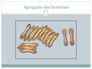 Agregação das hemácias
 