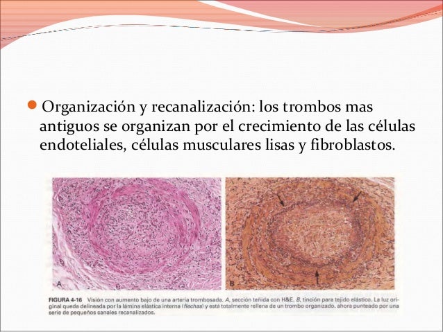 Las sanguijuelas a la tromboflebitis en los pies