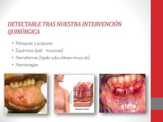 DETECTABLE TRAS NUESTRA INTERVENCIÓN
QUIRÚRGICA
 •   Petequias y púrpuras
 •   Equimosis (piel –mucosas)
 •   Hematomas (tejido subcutáneo-musculo)
 •   Hemorragias
 