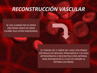 RECONSTRUCCIÓN VASCULAR

  SE USA CUANDO NO SE DESEA
   OBLITERAR VASOS DE GRAN
CALIBRE QUE ESTAN SANGRANDO.




                                SE TOMAN LOS 2 CABOS DEL VASO CON PINZAS
                               ARTERIALES DE BOCADO ATRAUMÁTICO Y SE HACE
                                ARTERIORRAFIA O RECONSTRUCCIÓN ARTERIAL
                                  PARA RESTABLECER EL FLUJO DE SANGRE AL
                                            RETIRAR LAS PINZAS.
 