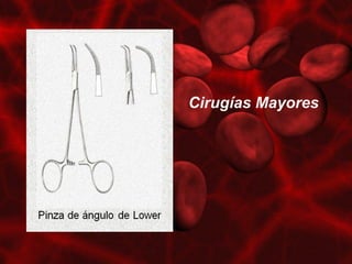 Cirugías Mayores
 