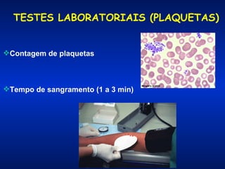 TESTES LABORATORIAIS (PLAQUETAS)
Contagem de plaquetas

Tempo de sangramento (1 a 3 min)

 