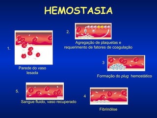 HEMOSTASIA
2.
Agregação de plaquetas e
requerimento de fatores de coagulação

1.

3.
Parede do vaso
lesada

Formação do plug hemostático

5.
4.
Sangue fluido, vaso recuperado
Fibrinólise

 