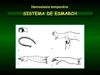 SISTEMA DE ESMARCHSISTEMA DE ESMARCH
Hemostasia temporária
 