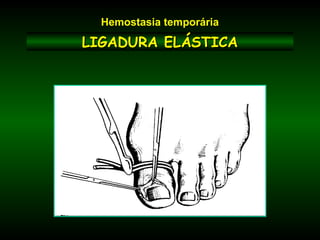 LIGADURA ELÁSTICALIGADURA ELÁSTICA
Hemostasia temporária
 