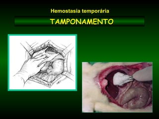 TAMPONAMENTOTAMPONAMENTO
Hemostasia temporária
 