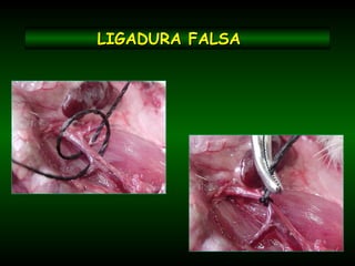 LIGADURA FALSALIGADURA FALSA
 